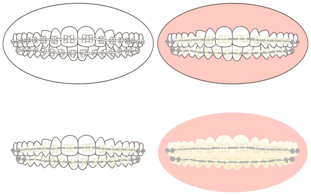 セラミックブラケット矯正